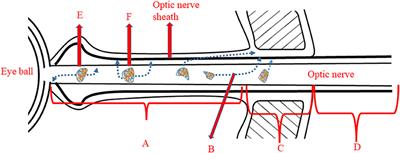 Pain Symptoms in Optic Neuritis